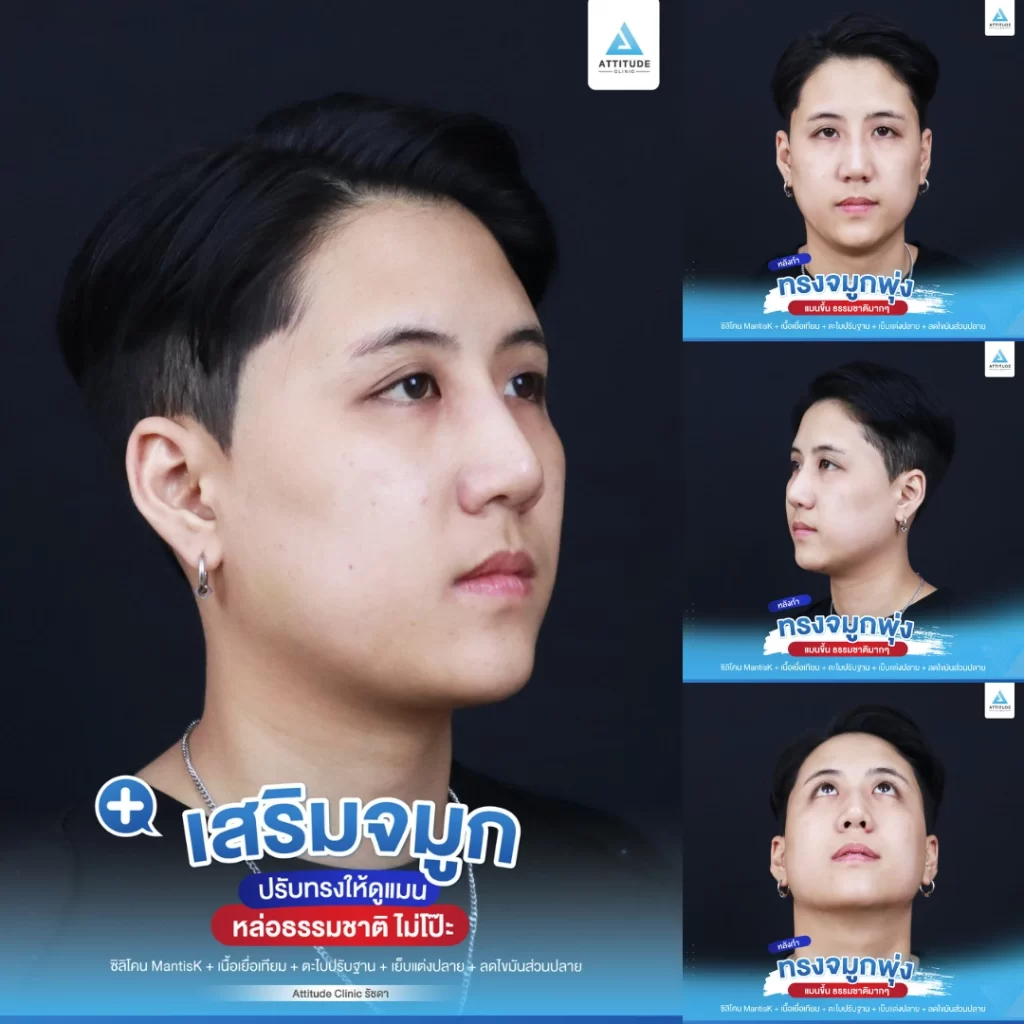 เสริมจมูก