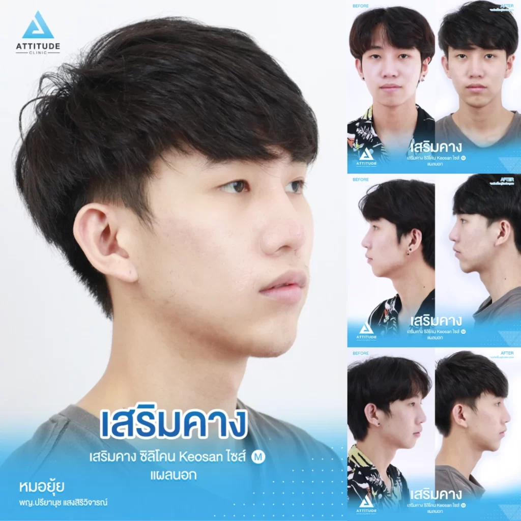 เสริมคาง