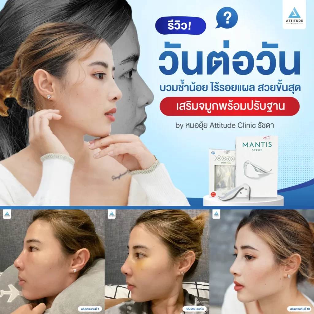 เสริมจมูก