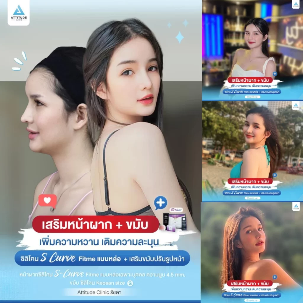 เสริมหน้าผาก เสริมขมับ
