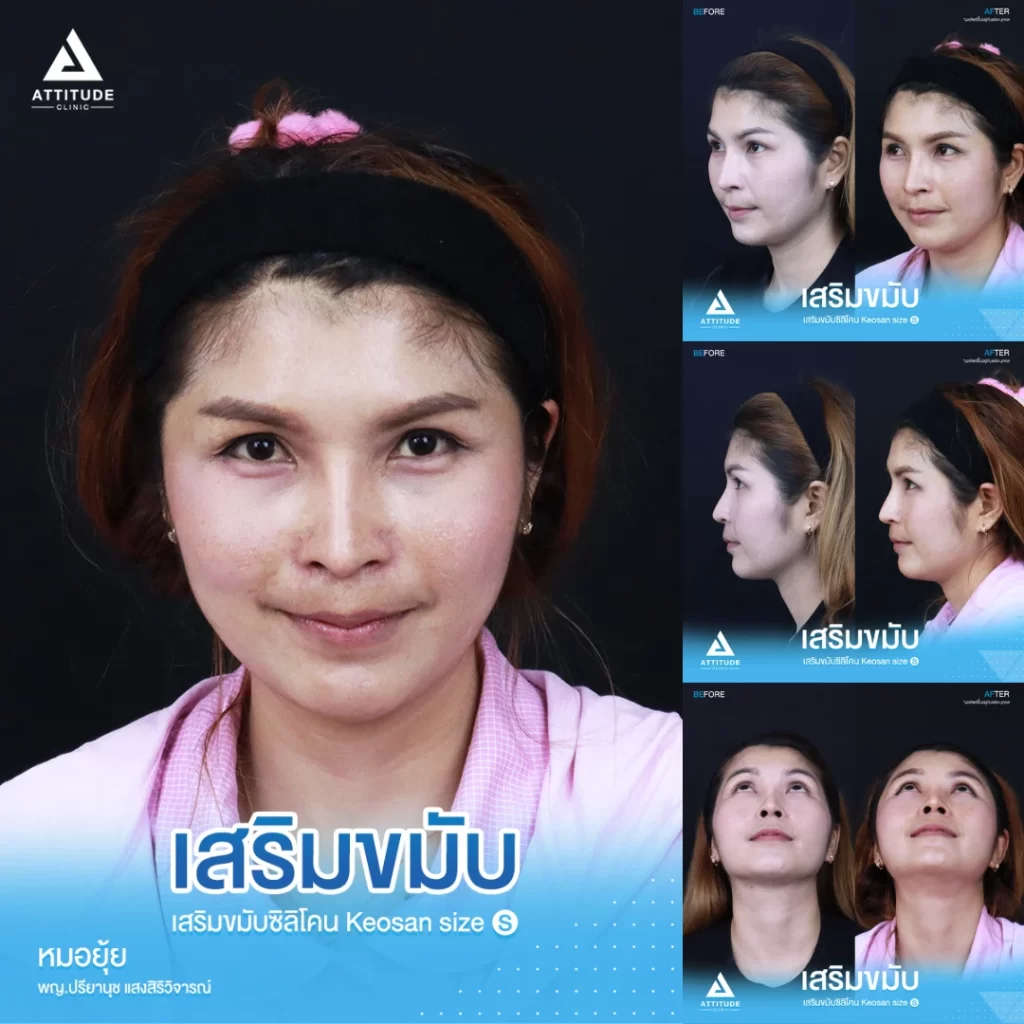 เสริมขมับ