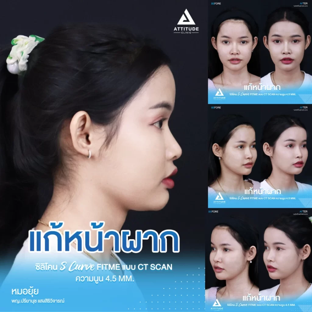 เสริมหน้าผาก