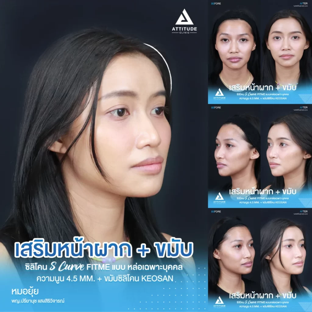 เสริมหน้าผาก