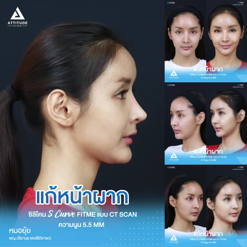 เสริมหน้าผาก