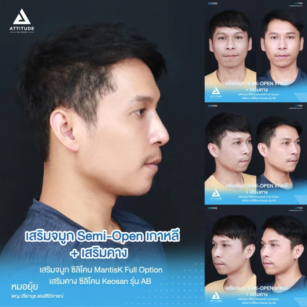 เสริมจมูก เสริมคาง