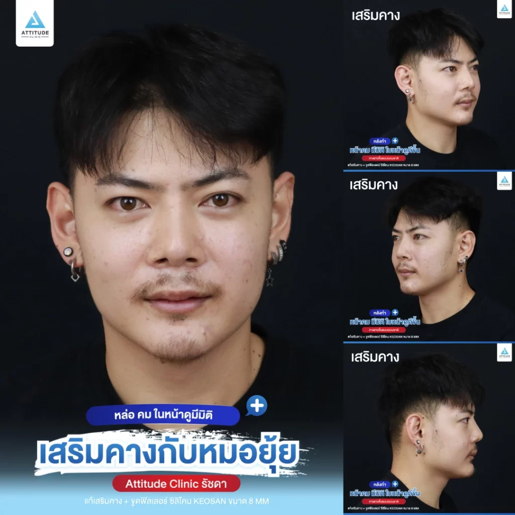 เสริมคาง