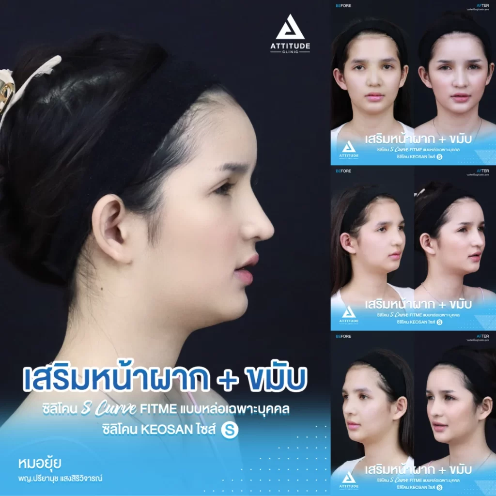 เสริมหน้าผาก
