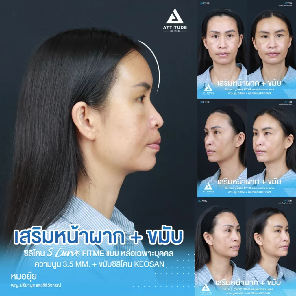 เสริมหน้าผาก เสริมขมับ