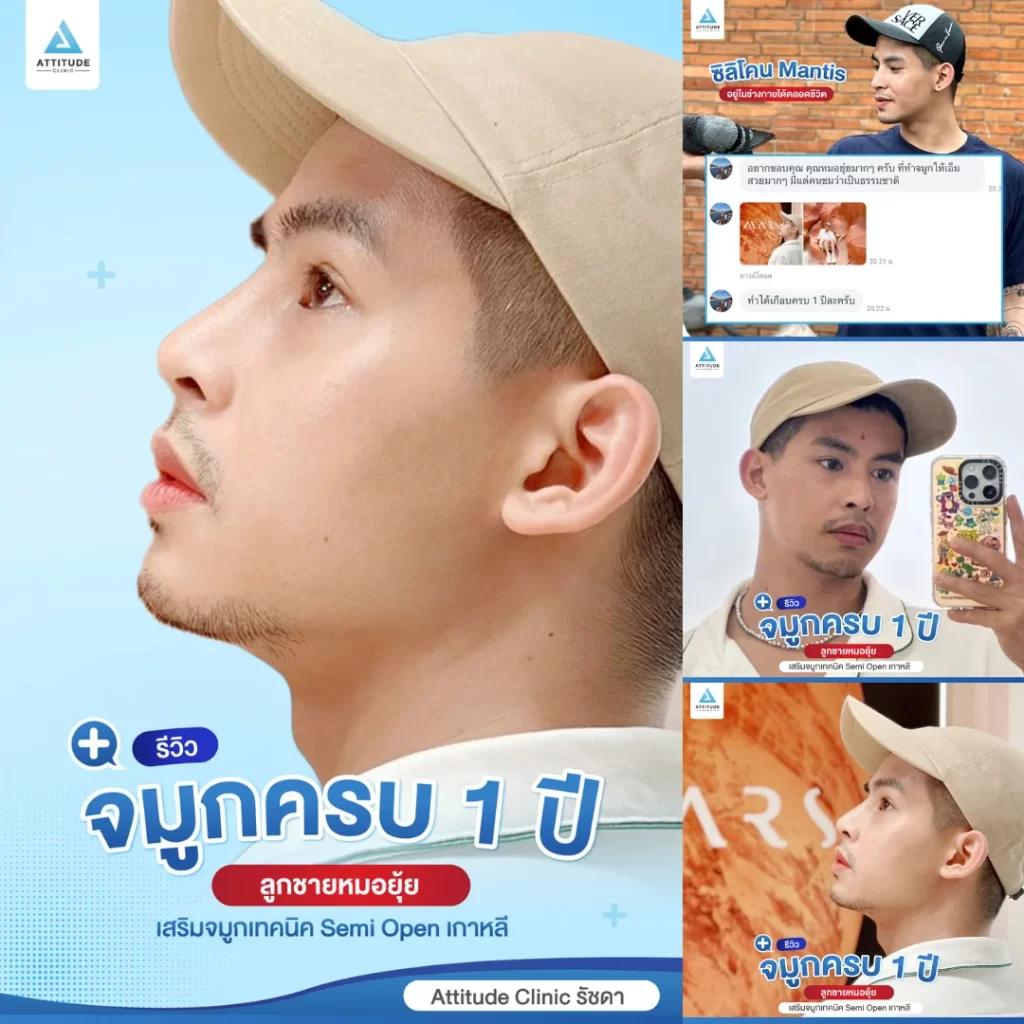 เสริมจมูก
