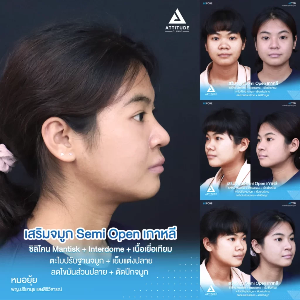เสริมจมูก