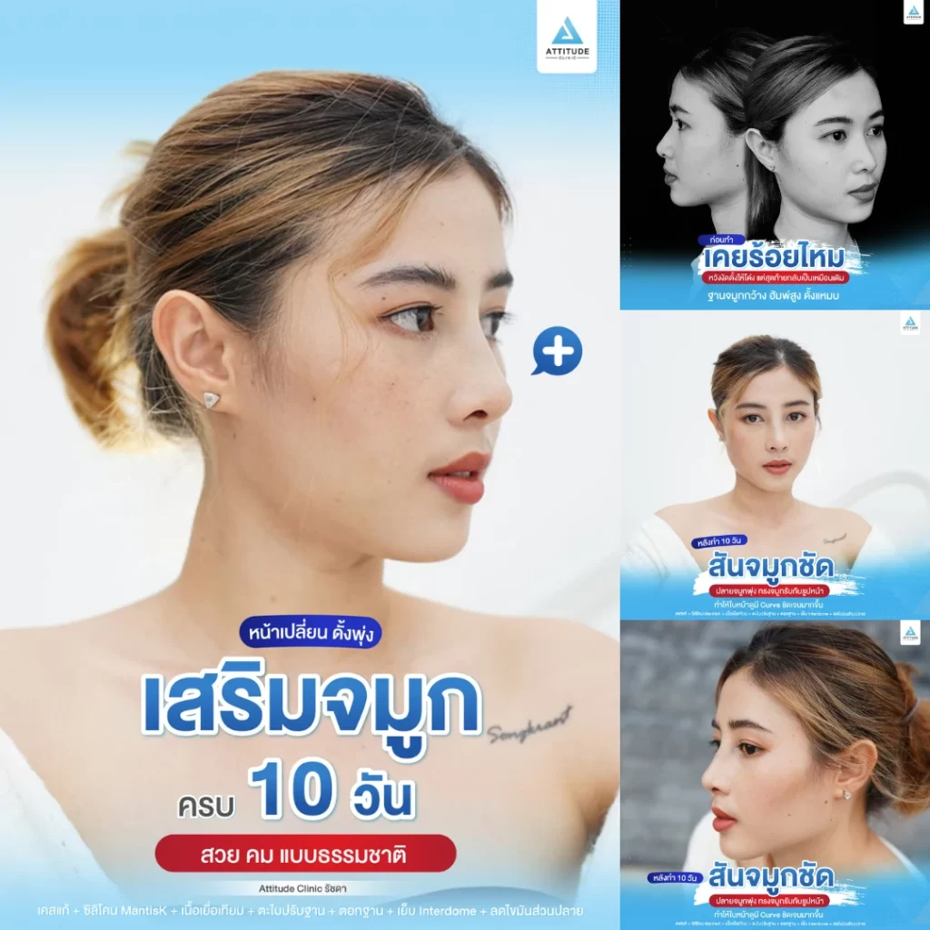 เสริมจมูก