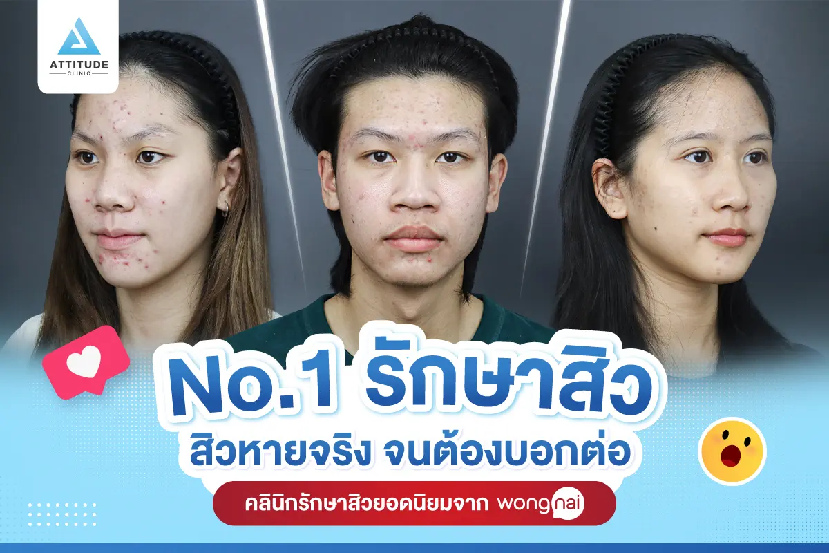 No.1 รักษาสิว = โนหนึ่งรักษาสิว สิวหายจริงจนต้องบอกต่อ ! 