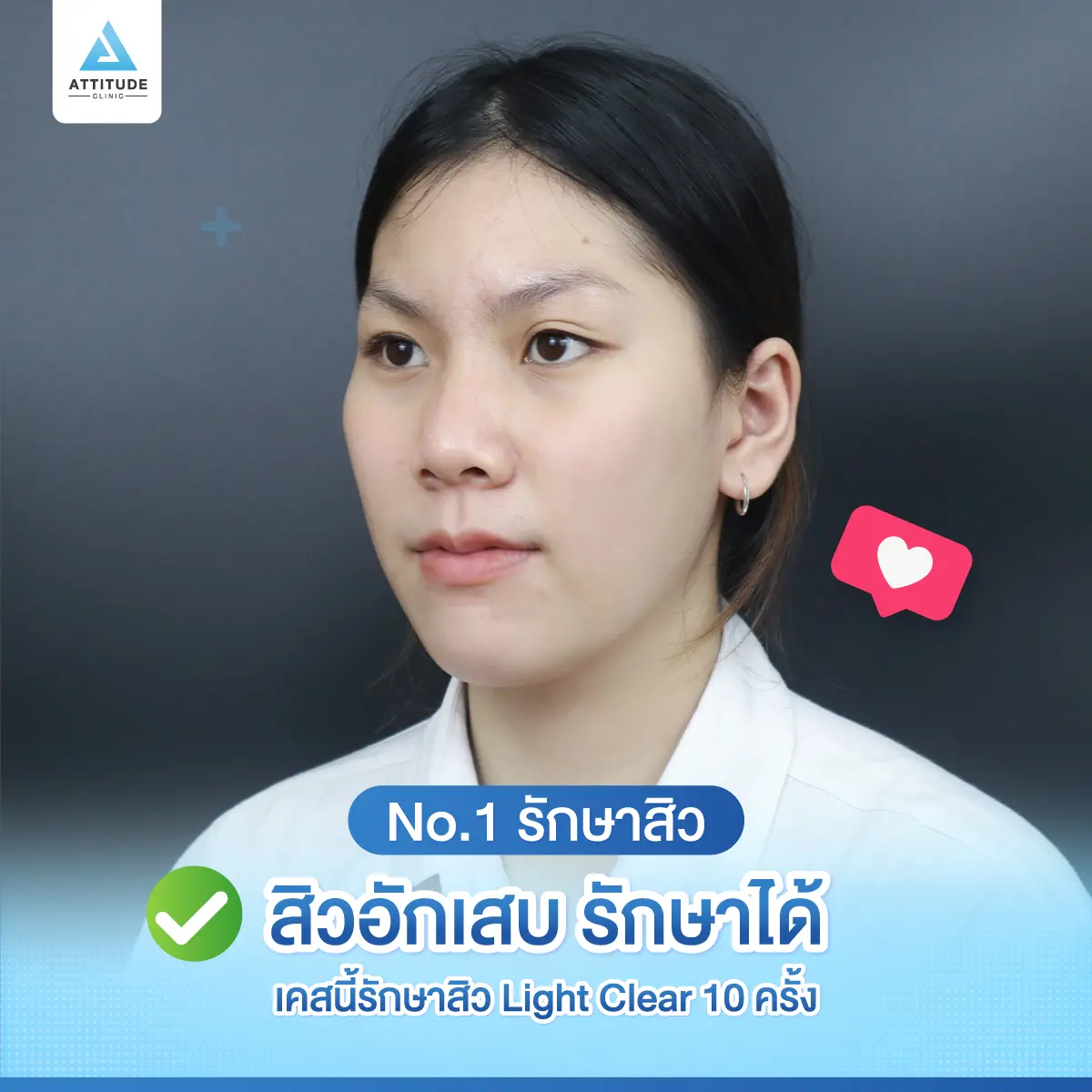 No.1 รักษาสิว = โนหนึ่งรักษาสิว สิวหายจริงจนต้องบอกต่อ ! 