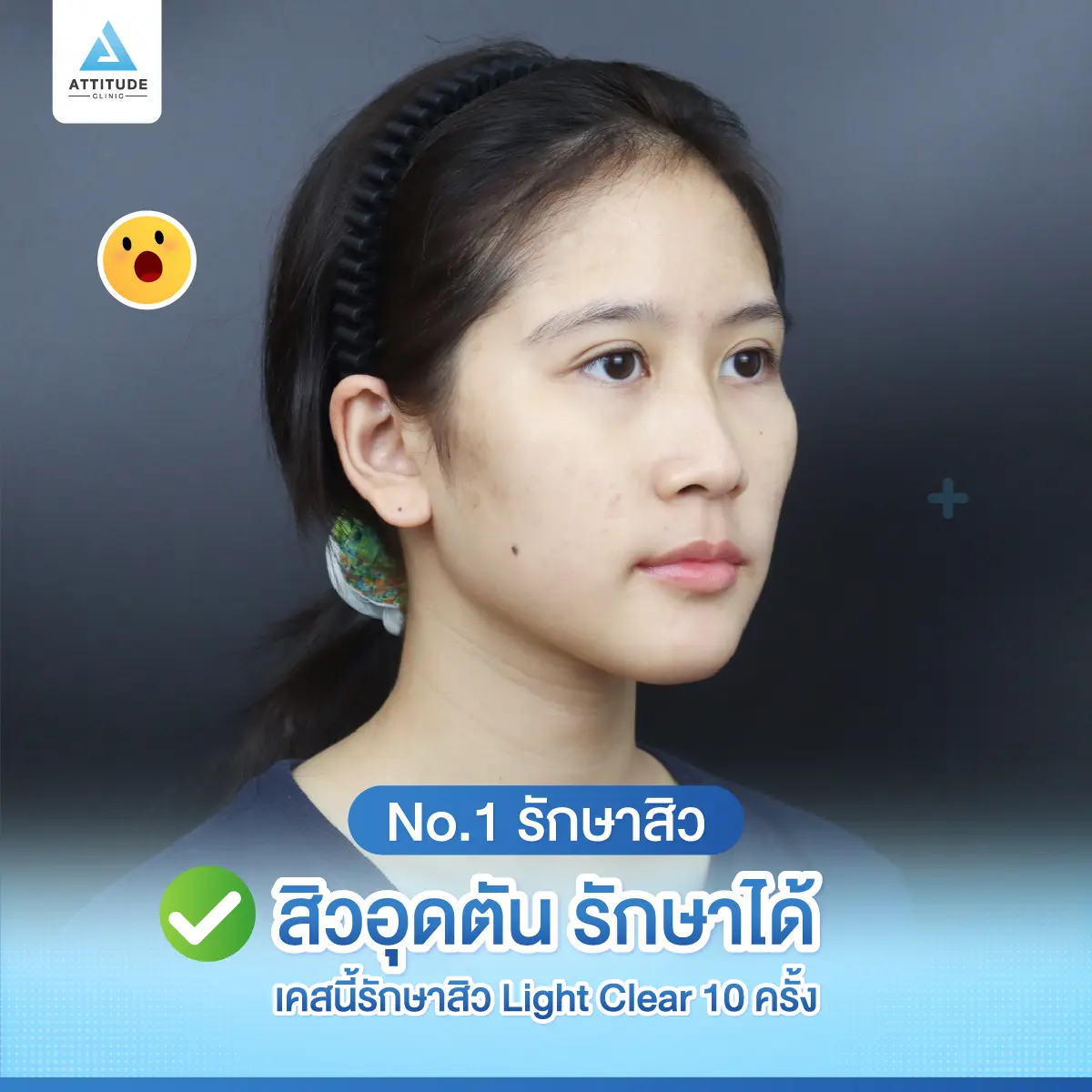 No.1 รักษาสิว = โนหนึ่งรักษาสิว สิวหายจริงจนต้องบอกต่อ ! 