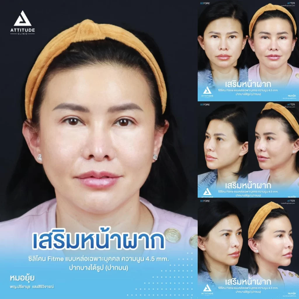 เสริมหน้าผาก