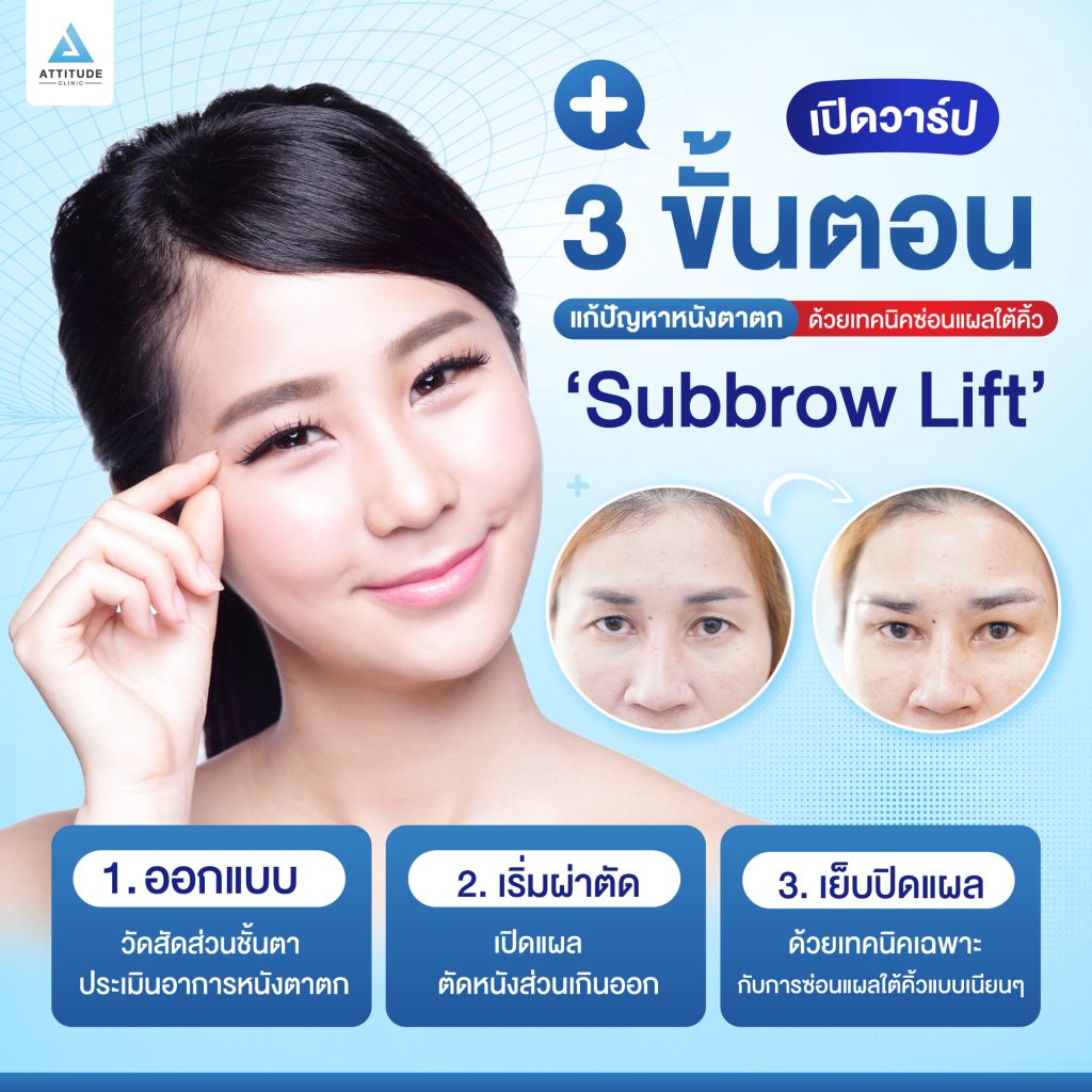 ผ่าตัดยกหางตา