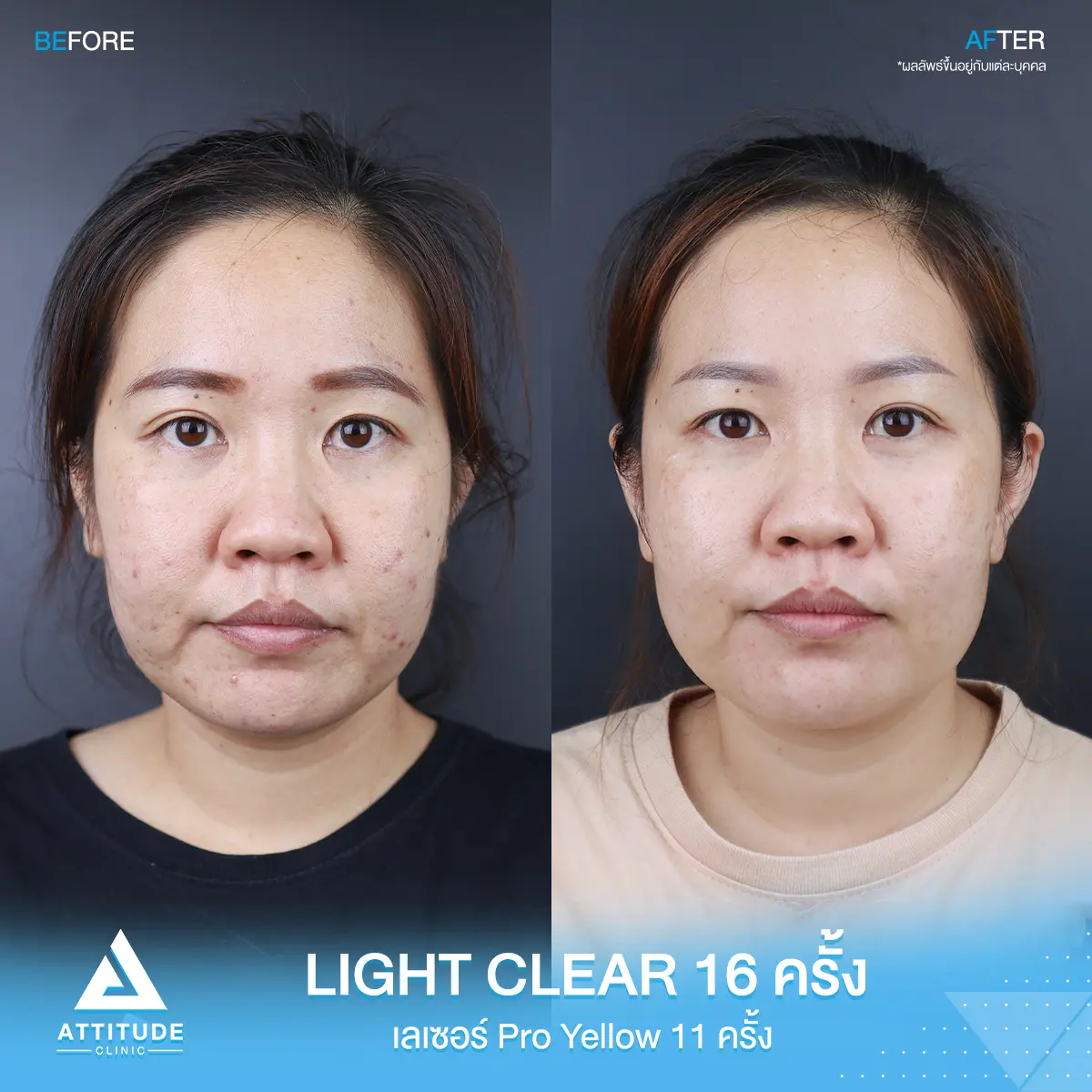 รีวิวรักษาสิว ด้วยการฉายแสง Light Clear 7 ขั้นตอน จำนวน 16 ครั้ง และเลเซอร์ Pro Yellow เน้นลดรอยแดงสิว ลดสิวอักเสบ ผิวกระจ่างใส จำนวน 11 ครั้ง ของคุณณัฐกาล ที่มีปัญหาสิว และรอยสิว หลังรักษาครบคอร์สตอนนี้หน้าใส มั่นใจขึ้นสุดๆ