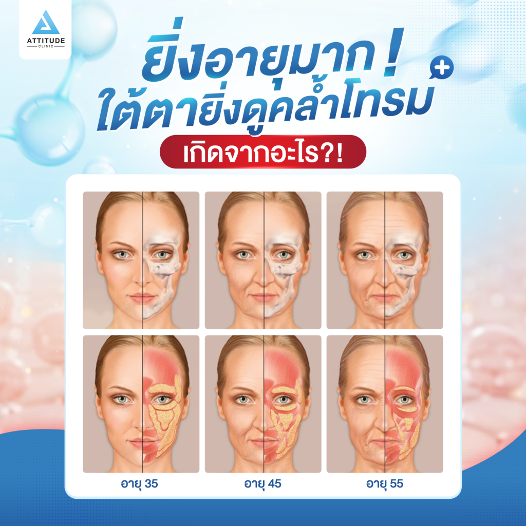 ยิ่งอายุมาก ใต้ตายิ่งดูคล้ำโทรม เกิดจากอะไร?