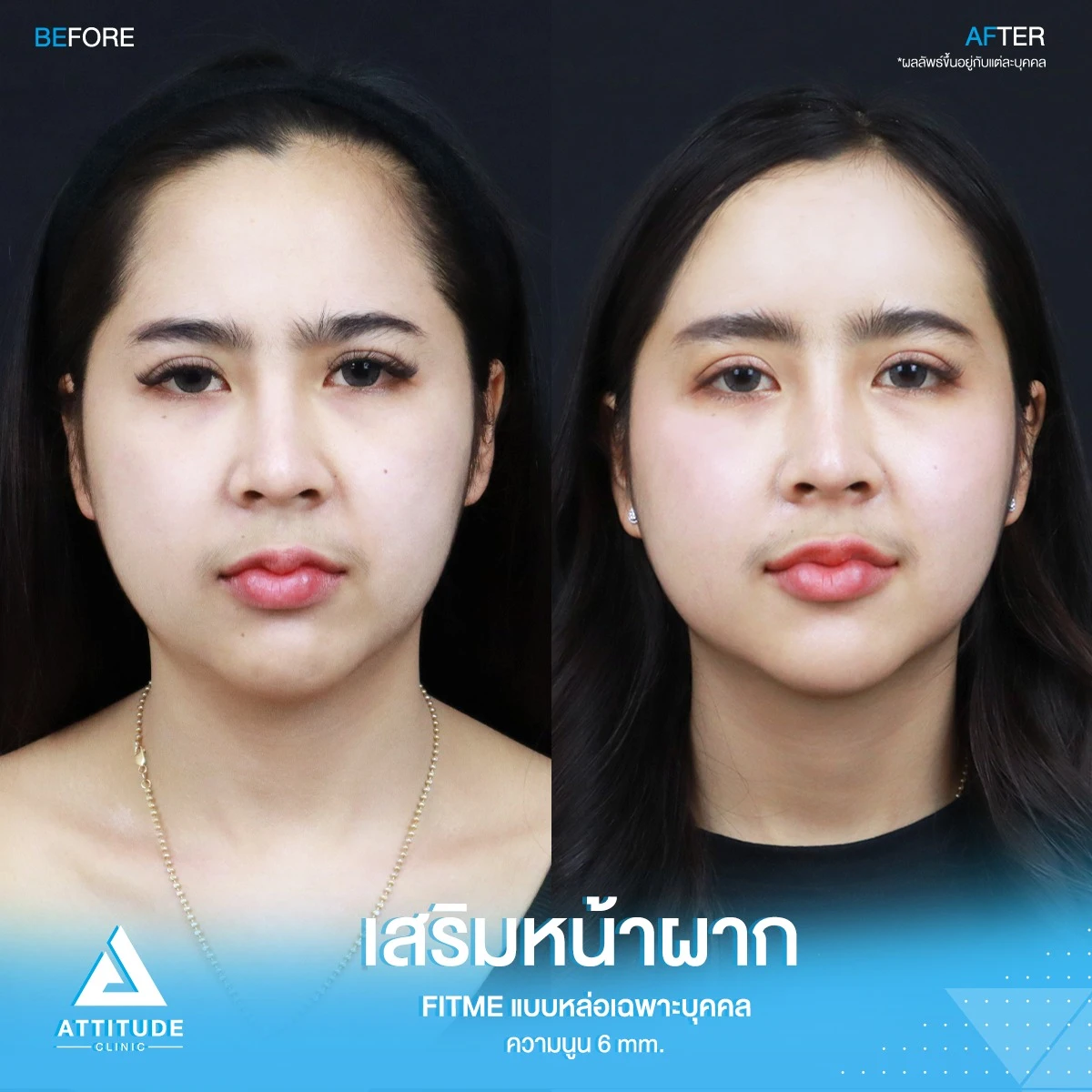 เสริมหน้าผาก
