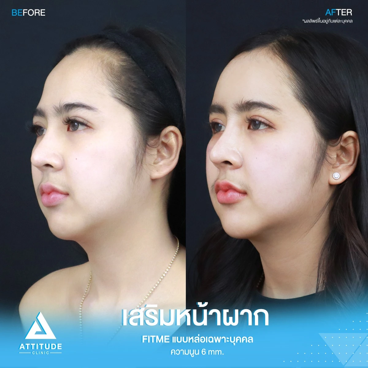 เสริมหน้าผาก