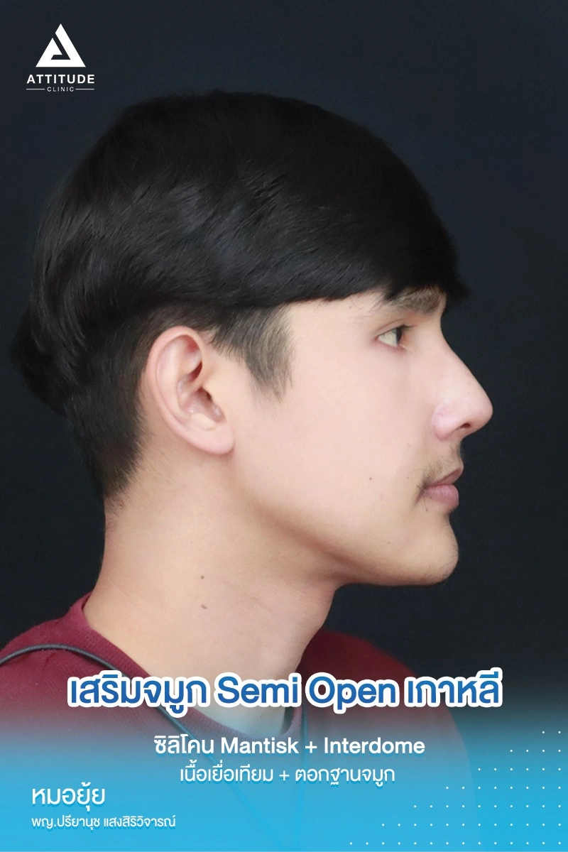 เสริมจมูก