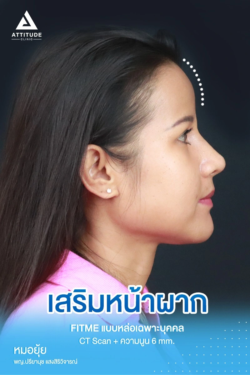 เสริมหน้าผาก