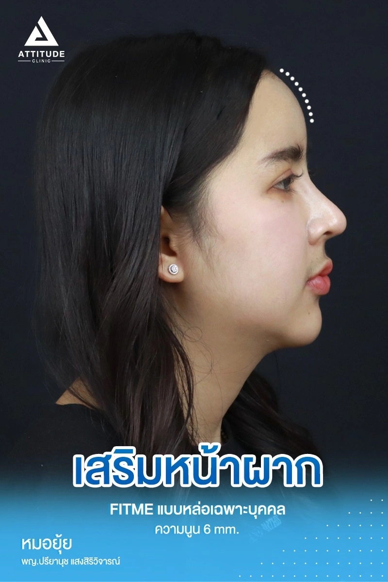 เสริมหน้าผาก