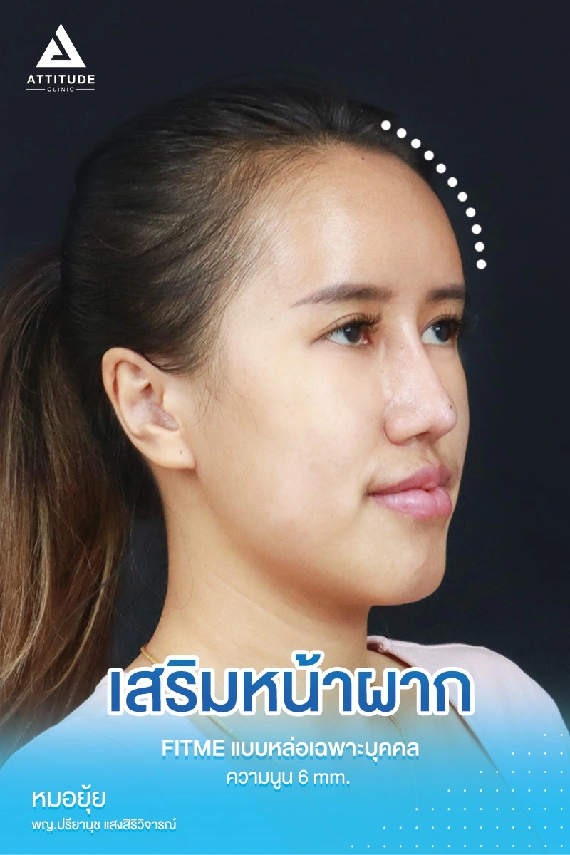 เสริมหน้าผาก
