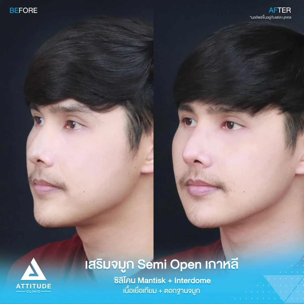 เสริมจมูก