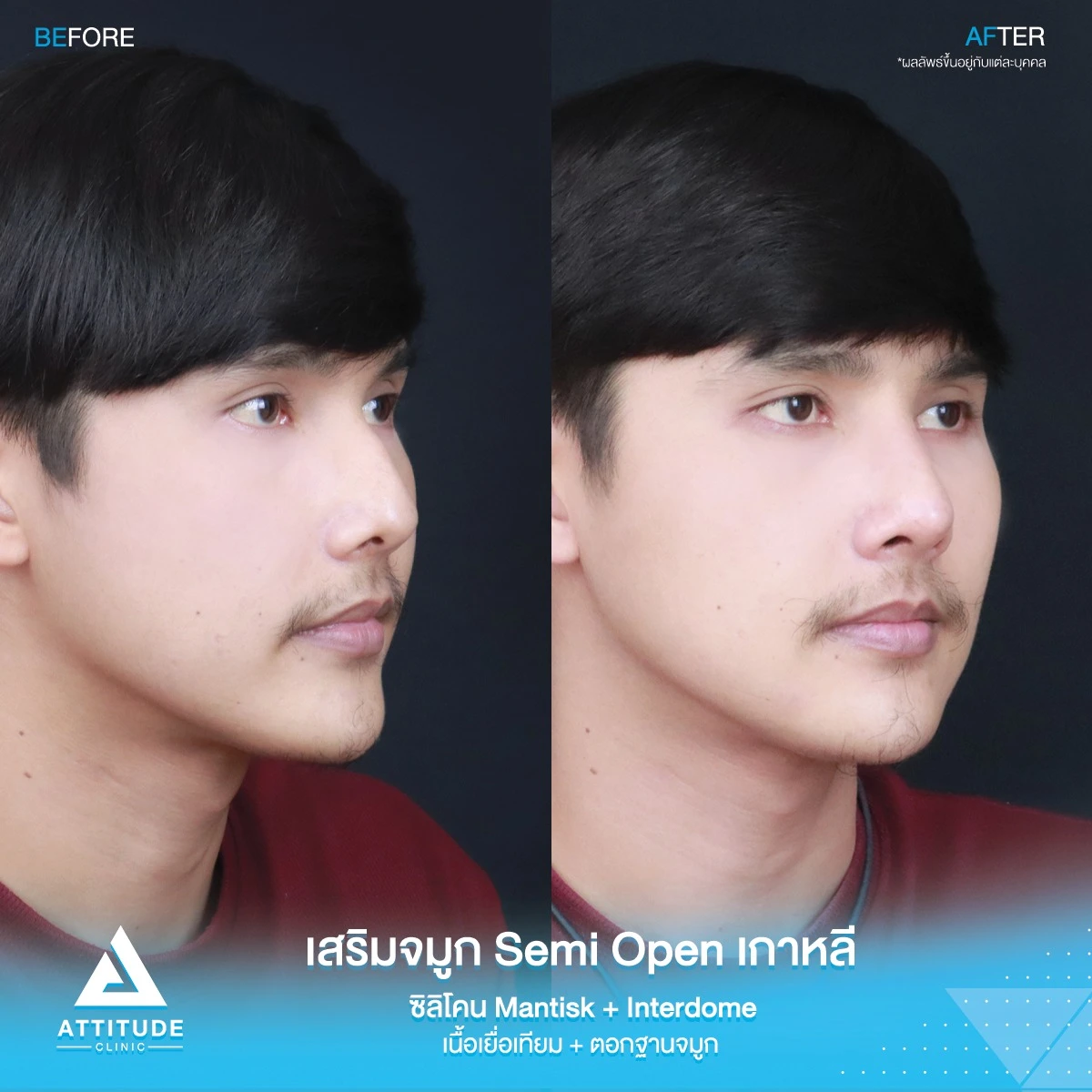เสริมจมูก
