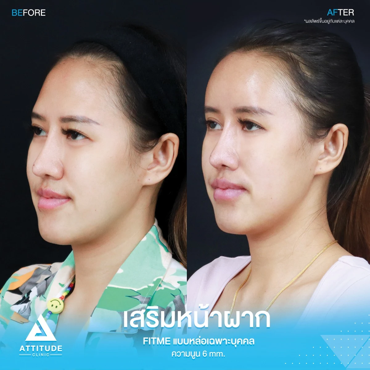 เสริมหน้าผาก
