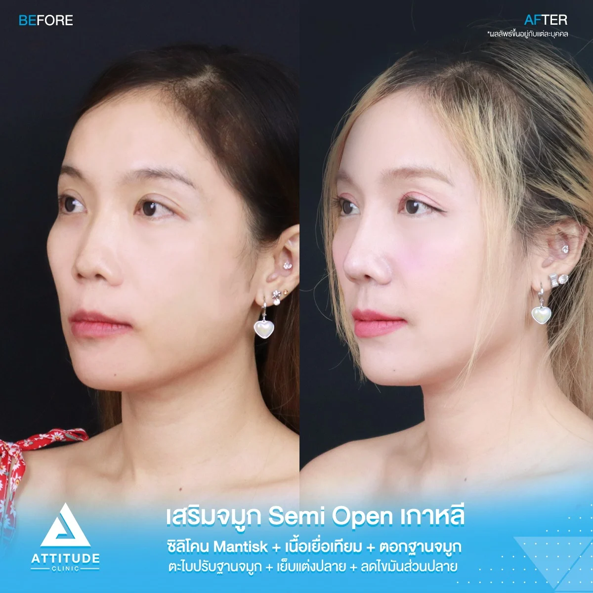 เสริมจมูก