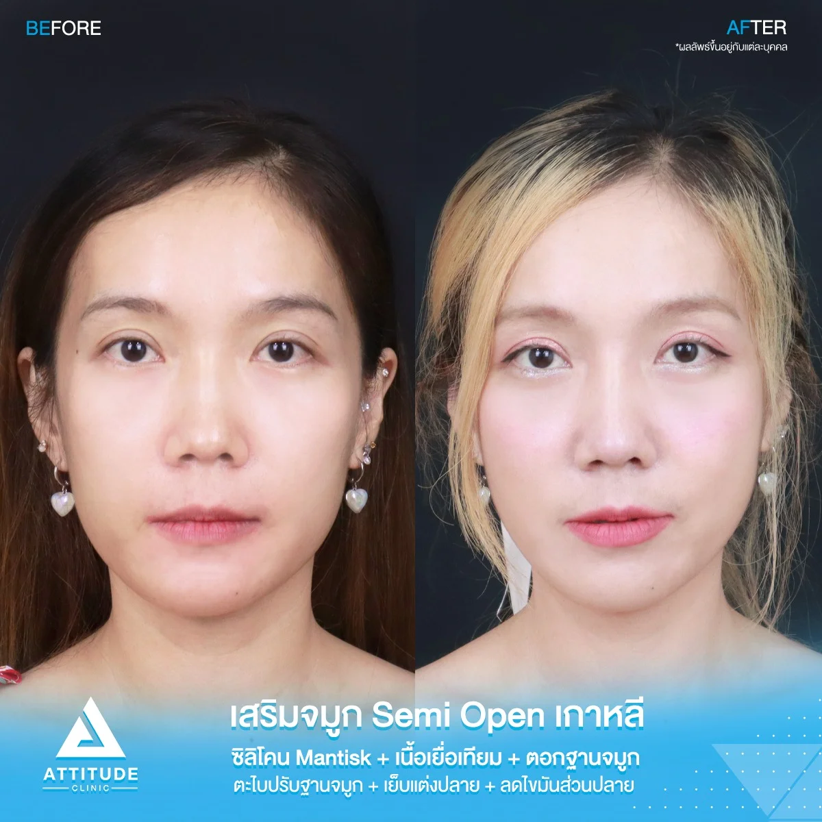 เสริมจมูก