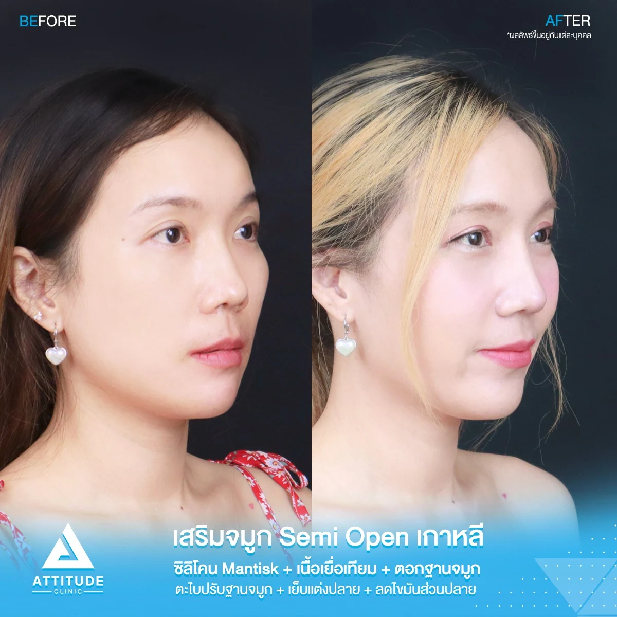 เสริมจมูก