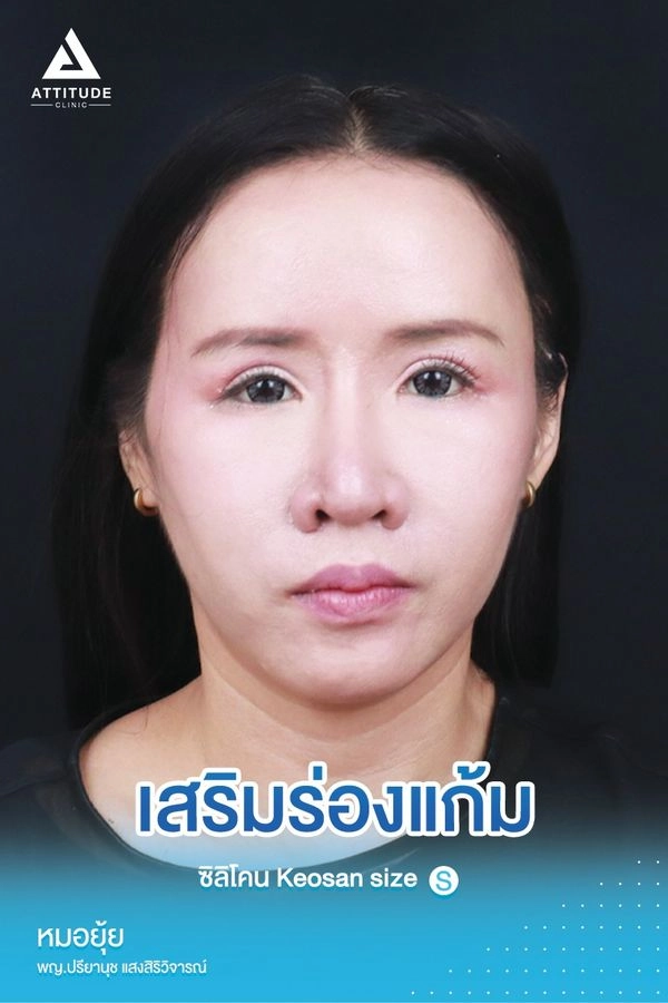 เสริมร่องแก้ม