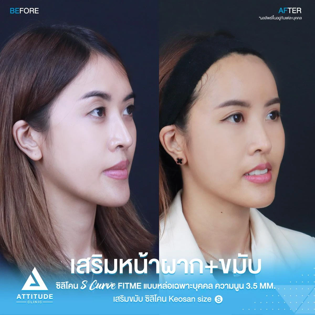 เสริมหน้าผาก