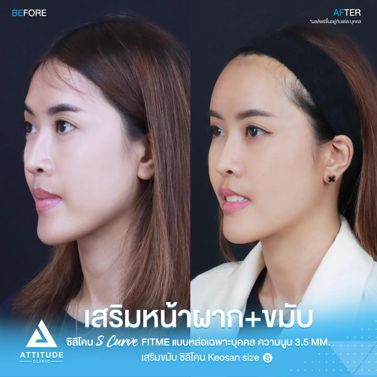 เสริมหน้าผาก