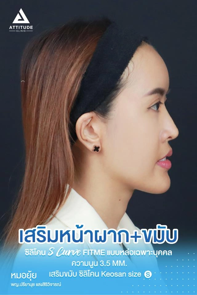 เสริมหน้าผาก