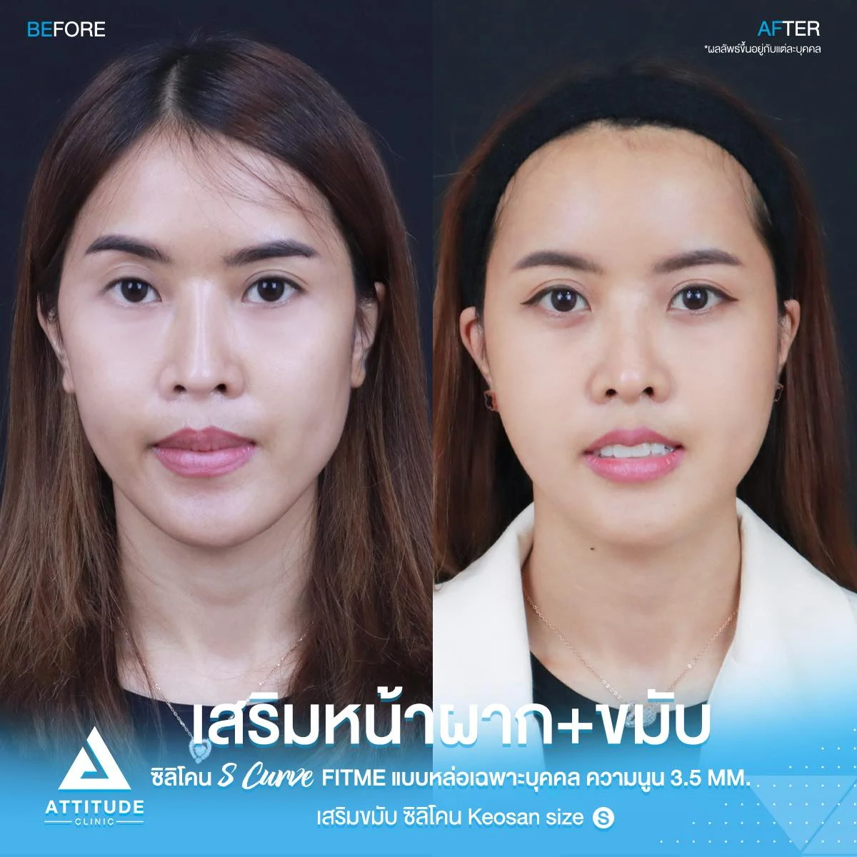 เสริมหน้าผาก