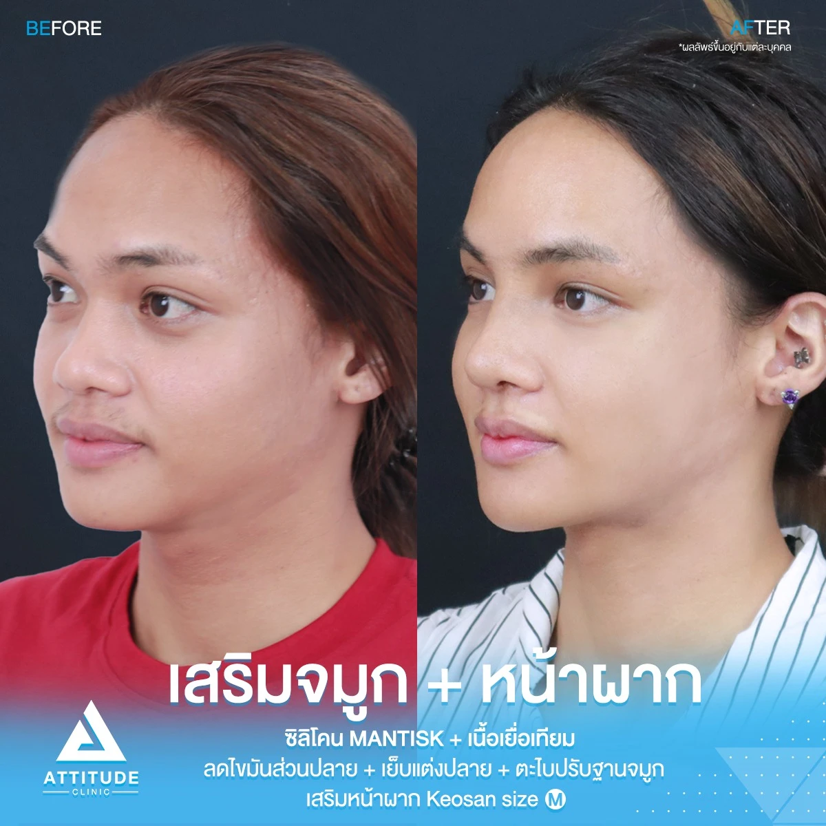 เสริมจมูก เสริมหน้าผาก