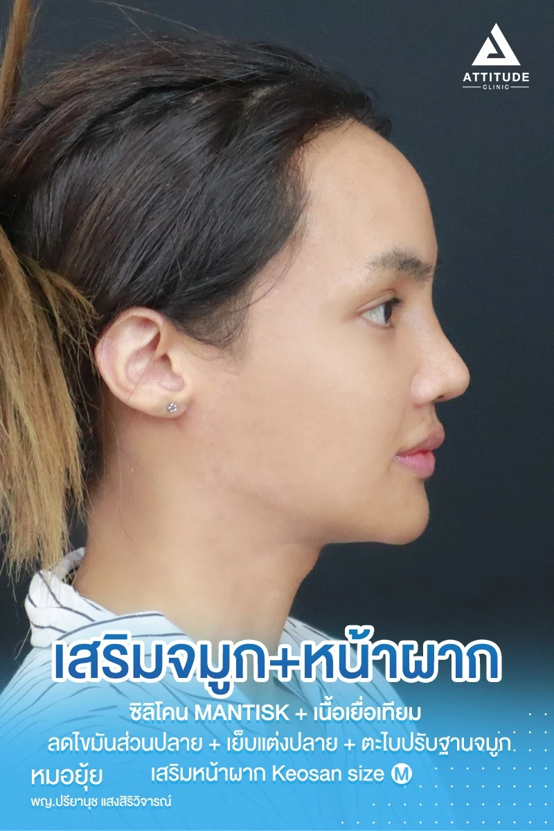 เสริมจมูก เสริมหน้าผาก