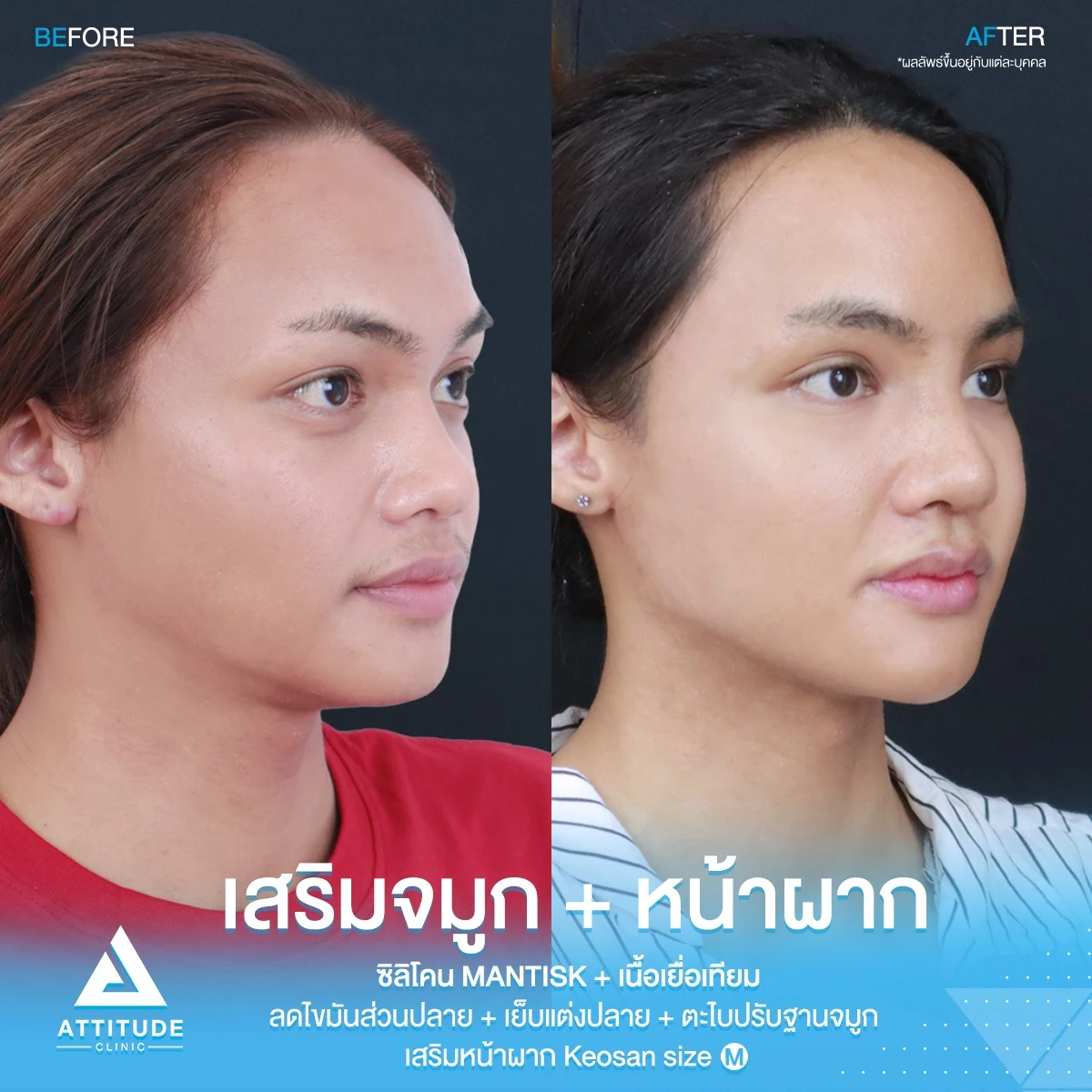 เสริมจมูก เสริมหน้าผาก