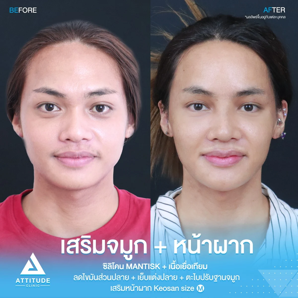 เสริมจมูก เสริมหน้าผาก