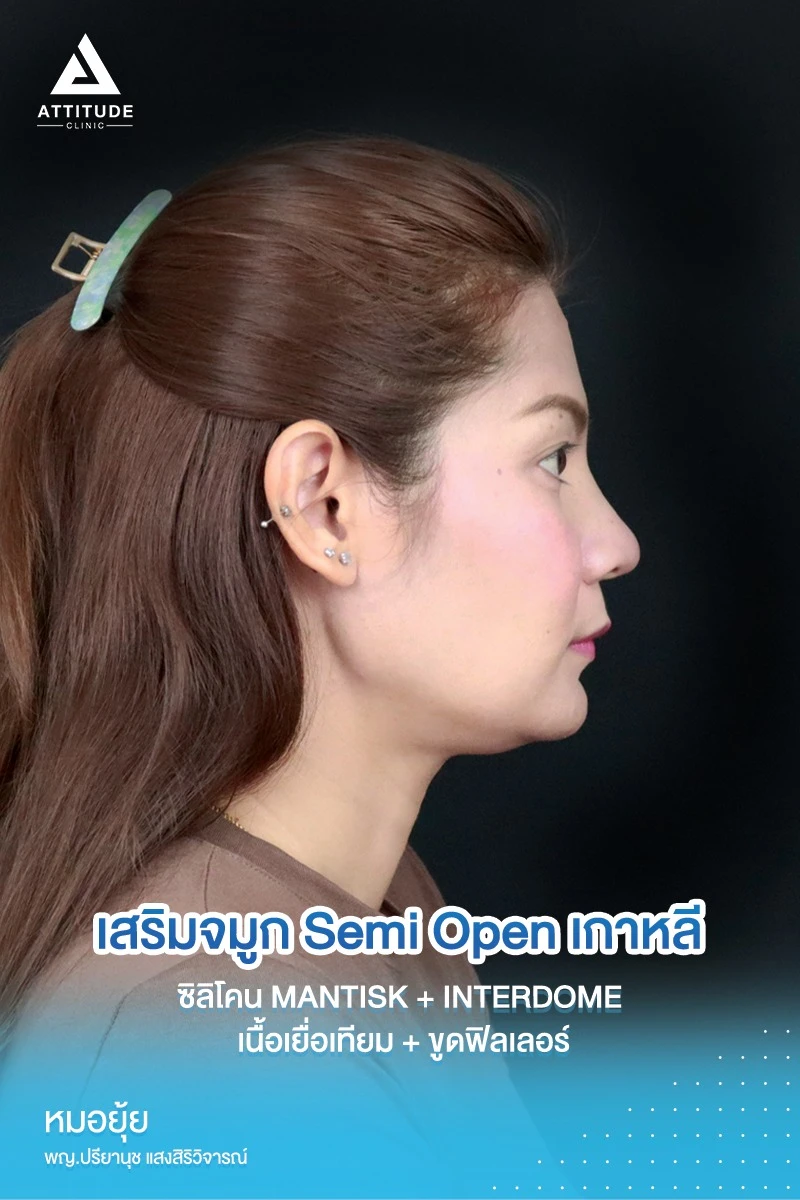 เสริมจมูก