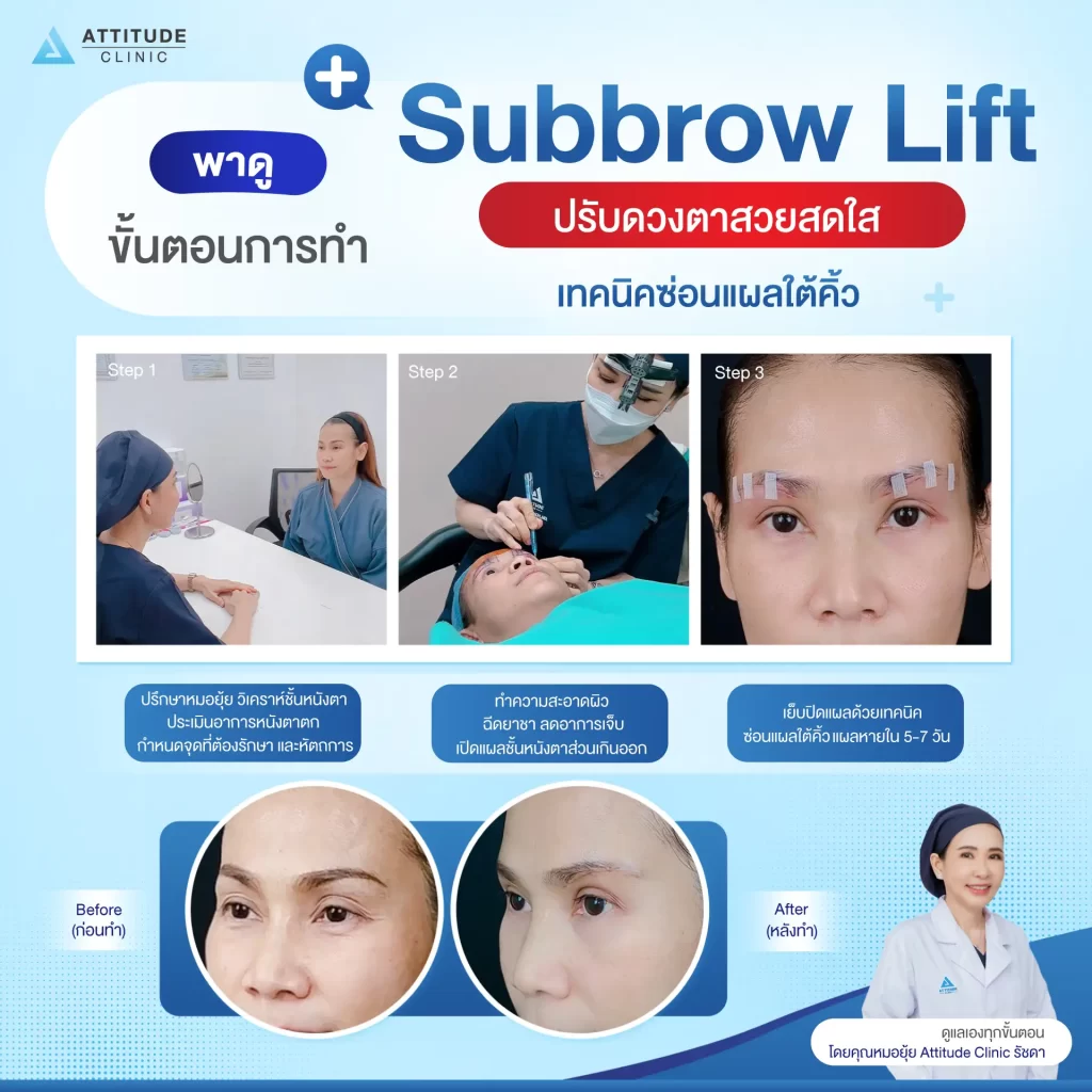 ผ่าตัดยกหางตา Sub-Brow-Lift