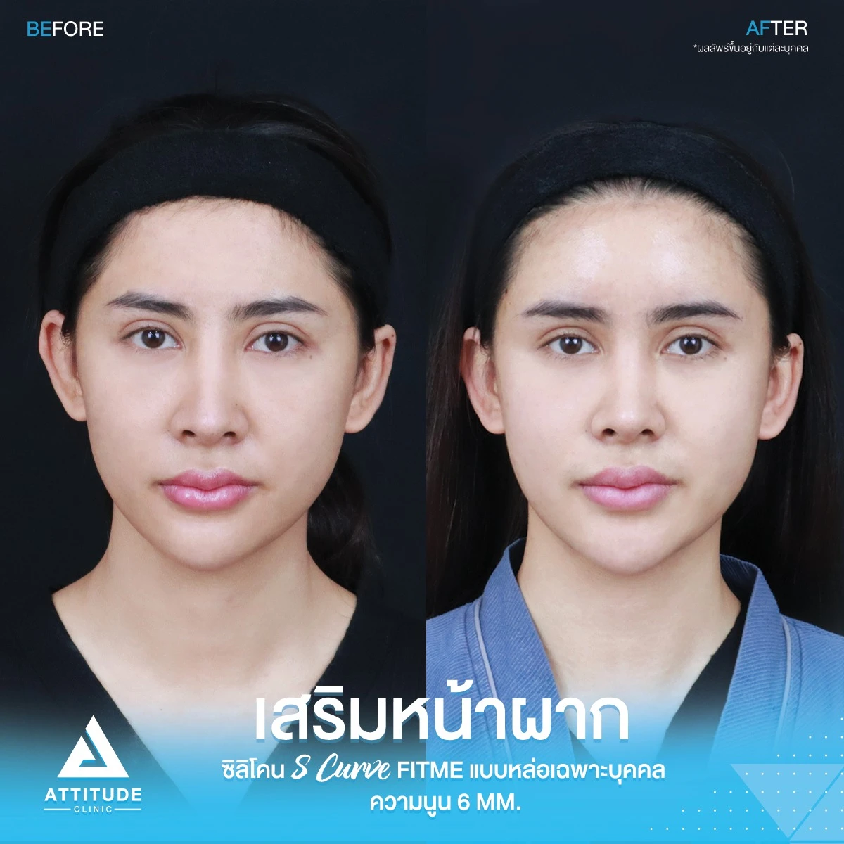 เสริมหน้าผาก