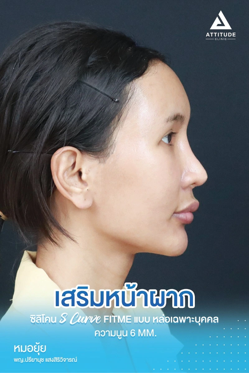 เสริมหน้าผาก