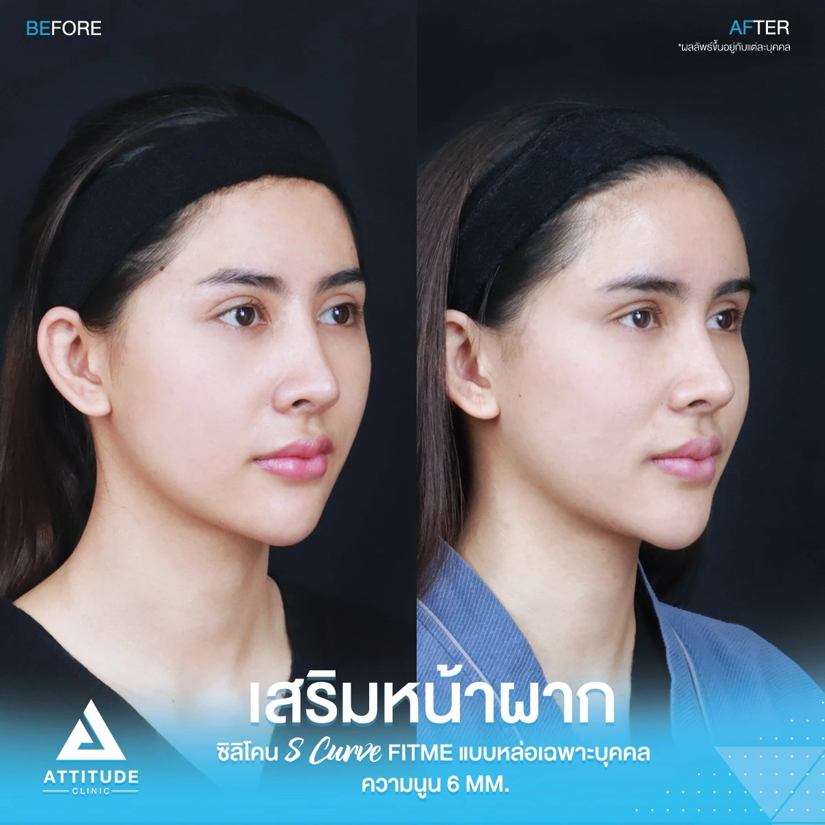 เสริมหน้าผาก