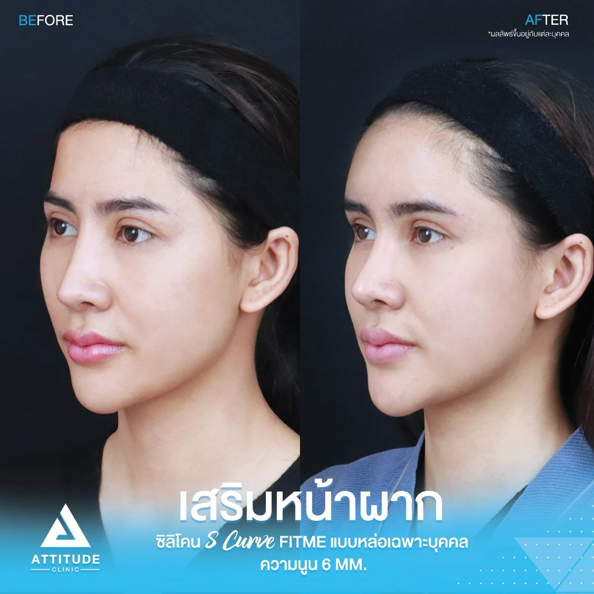 เสริมหน้าผาก