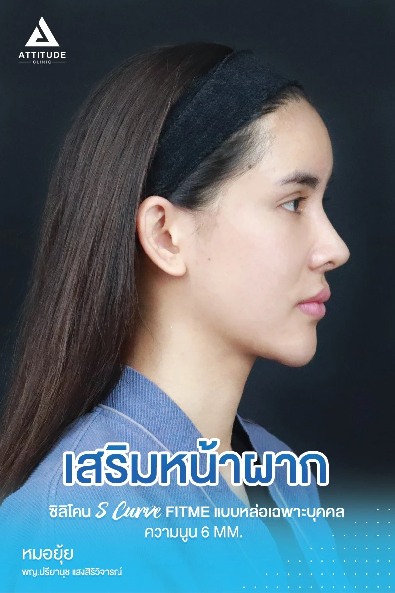 เสริมหน้าผาก